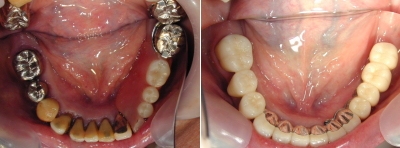 治療前の下顎面観と後