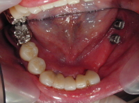 インプラント稙立後１週間