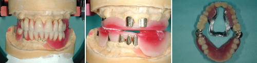 義歯の製作手順