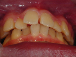 歯列矯正治療前