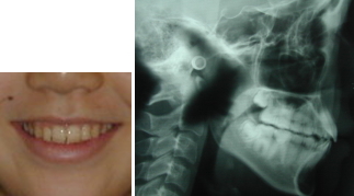 治療後の正面の口元の写真とセファロレントゲン