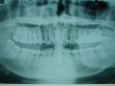 下あごの親知らずが原因で発症した顎関節症患者さんのレントゲン写真