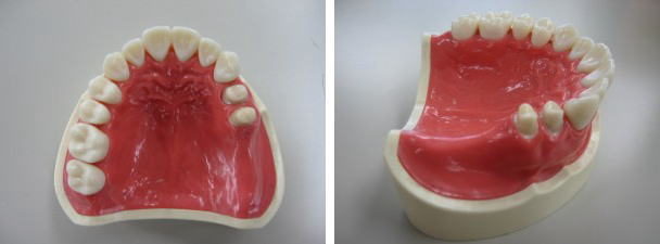 テレスコープ義歯システム