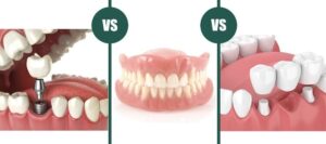 インプラント・ブリッジ・入れ歯